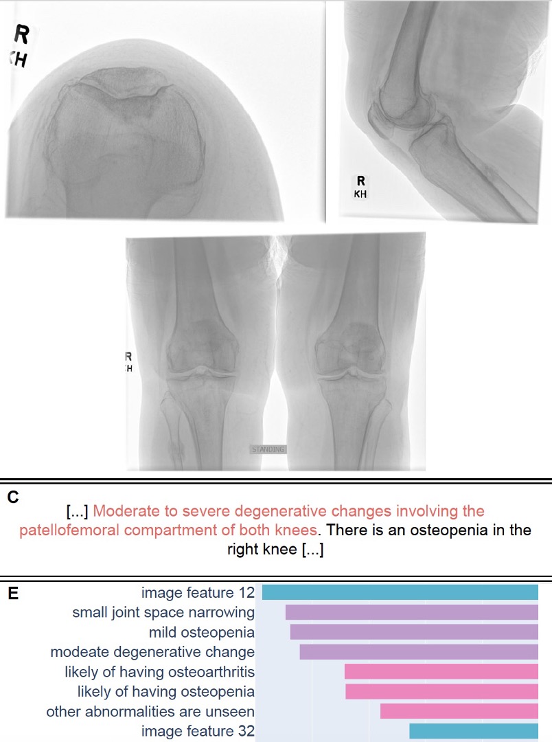 Monica Cheng, MD (@monicacheng_) on Twitter photo RadGPT, a visual-language AI system enhanced by interactive human-AI refinement, has the potential to aid in the diagnosis and interpretation of knee radiographs <a href="/MGHMartinos/">MGH Martinos Center</a> <a href="/MGHImaging/">Mass General Imaging</a> <a href="/RSNA/">RSNA</a> #RadAdv <a href="/OxfordJournals/">Oxford Journals</a> <a href="/SusannaLeeRad/">Susanna I Lee</a> doi.org/10.1093/radadv… RadGPT, a visual-language AI system enhanced by interactive human-AI refinement, has the potential to aid in the diagnosis and interpretation of knee radiographs <a href="/MGHMartinos/">MGH Martinos Center</a> <a href="/MGHImaging/">Mass General Imaging</a> <a href="/RSNA/">RSNA</a> #RadAdv <a href="/OxfordJournals/">Oxford Journals</a> <a href="/SusannaLeeRad/">Susanna I Lee</a> doi.org/10.1093/radadv…