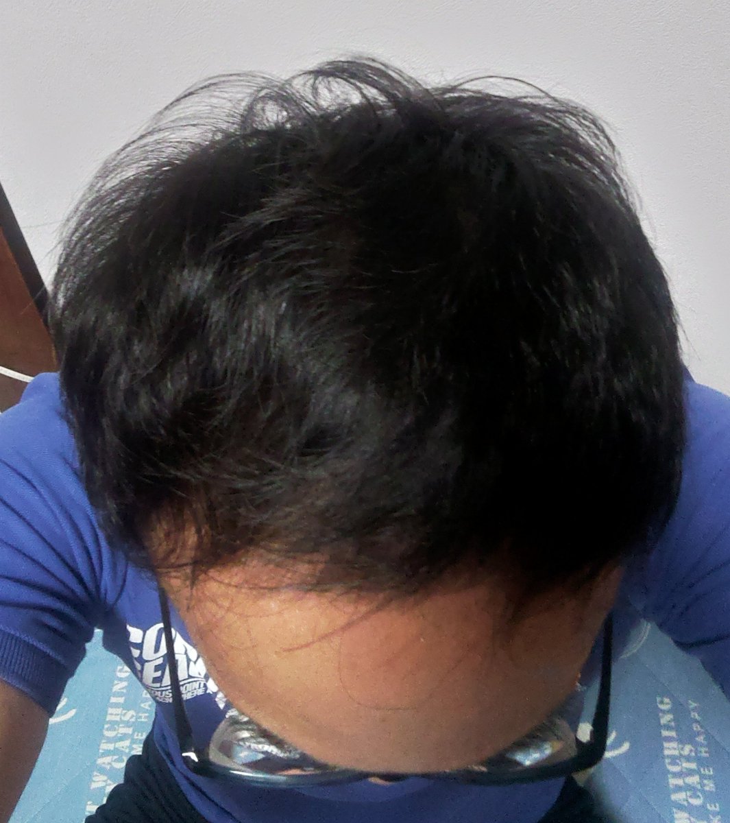 去年から丸一年でAGAの薬で
髪の毛増えました

#フォロワーのチャロナーに信じてもらえなさそうなことを言う