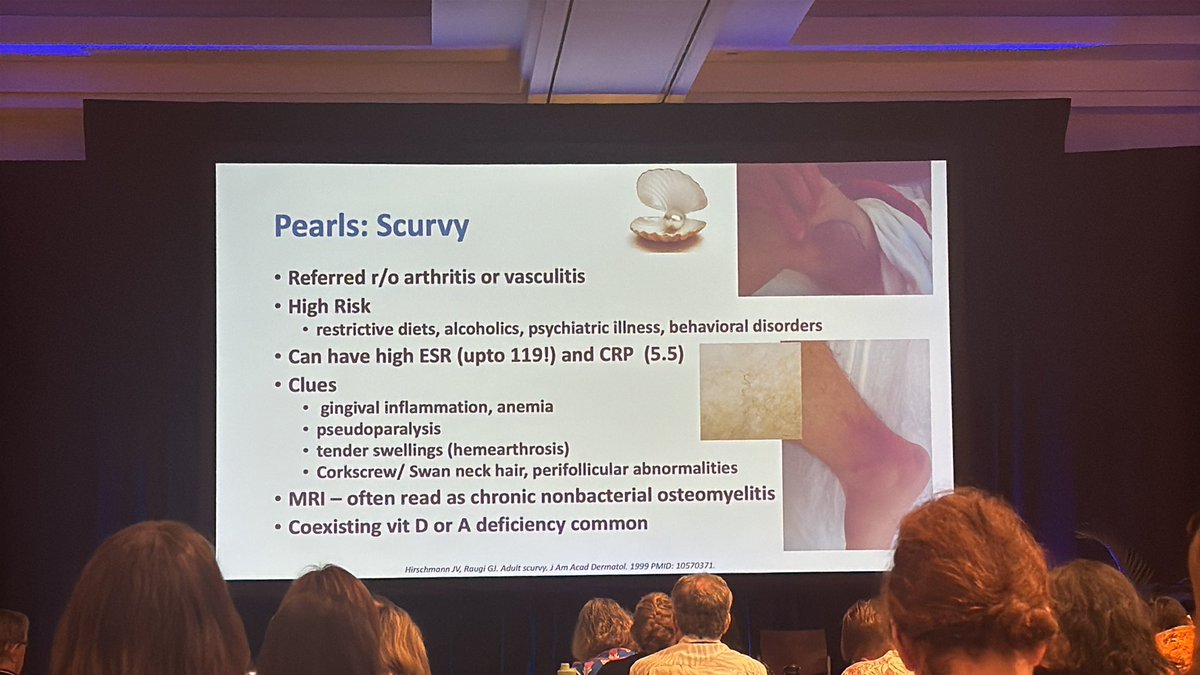 KDAO2011's tweet image. Pearl: Patients with scurvy can have elevated ESR and CRP. Buzzwords: corkscrew hair, gingivitis, microhemorrhages - Dr S Shenoi #RWCS