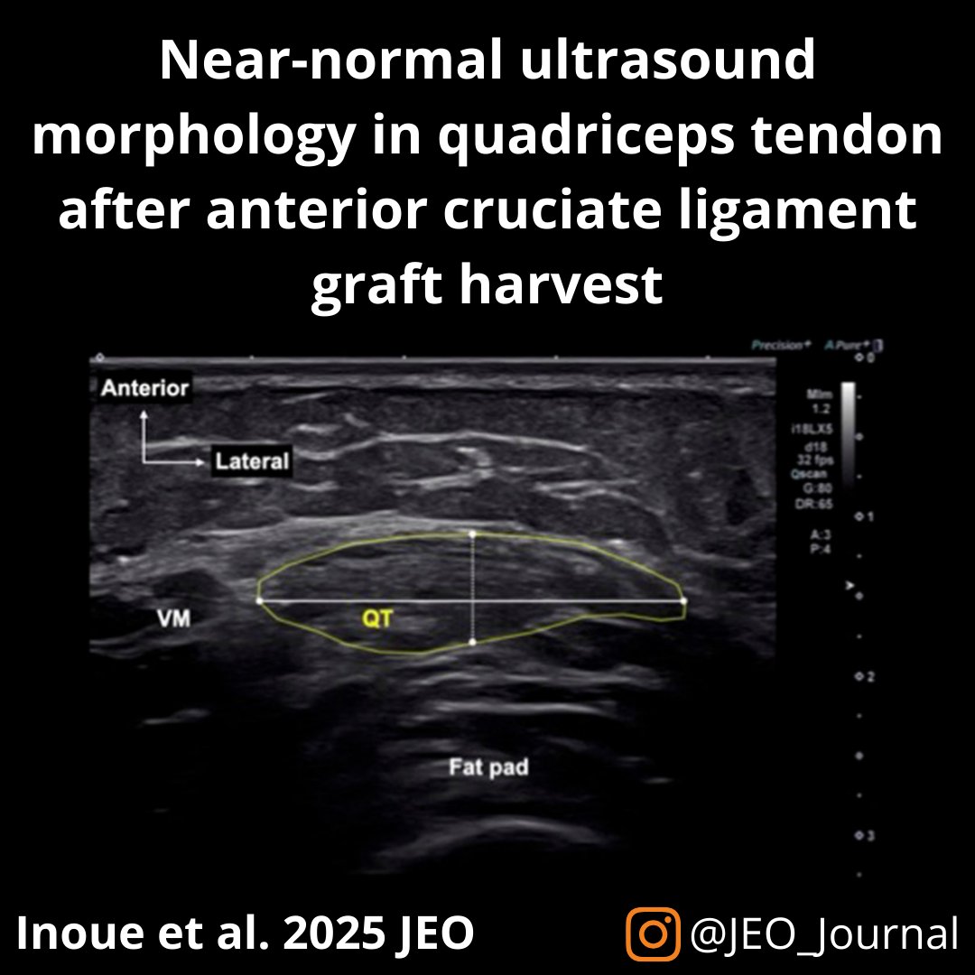 JEO_journal's tweet photo. This ultrasound-based study showed that at least 1 year after surgery, the QT morphology in patients who underwent QT autograft ACLR was comparable to that of the contralateral side throughout the entire harvest site. 

OPEN ACCESS : https://t.co/YYNGWeL5iR

#acl https://t.co/XOiY4RfPc1