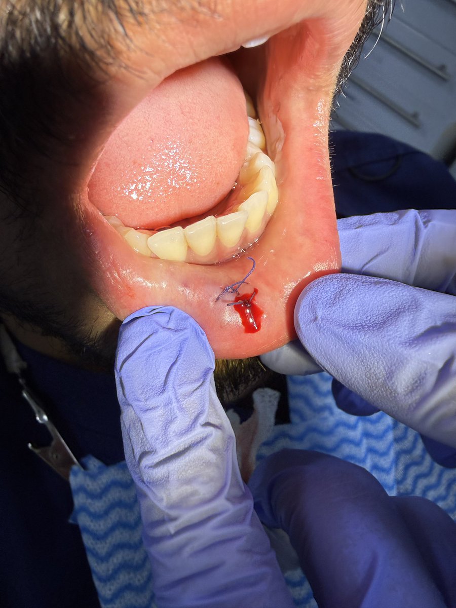 FaisalOR22's tweet photo. A 24-year-old male presented with a painless, fluctuant swelling on the right lower lip.

Based on clinical findings, the provisional diagnosis was mucocele.
An excisional biopsy was carried out and the specimen was submitted for histopathology to confirm the diagnosis. https://t.co/h6sbPysCea