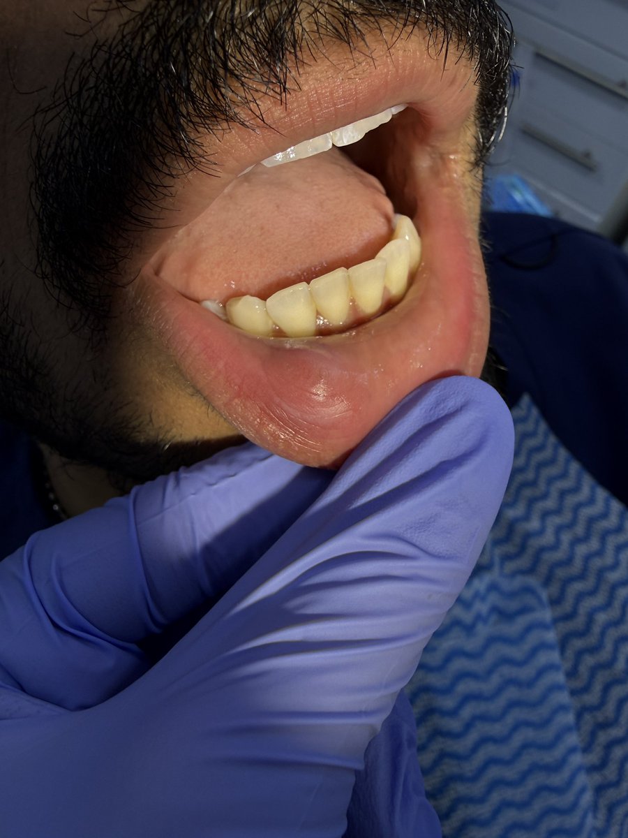 FaisalOR22's tweet photo. A 24-year-old male presented with a painless, fluctuant swelling on the right lower lip.

Based on clinical findings, the provisional diagnosis was mucocele.
An excisional biopsy was carried out and the specimen was submitted for histopathology to confirm the diagnosis. https://t.co/h6sbPysCea