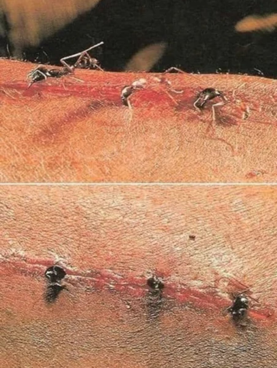 When Civil War surgeons exhausted their supplies of silk and horsehair sutures, they turned to the natural world. Army doctors, both Union and Confederate, observed that certain black ant species possessed mandibles strong enough to close wounds. Surgeons would position the ant's