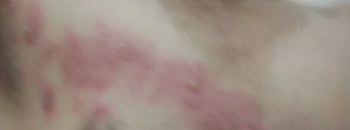 لي ثلاثة أيام مصاب ببثور وفيها ماء
 والم شديد جدا (الحمدالله) 
واعراض حمى بالكاد امشي..

هل هذا مايسمى الحزام الناري
موجود في صدري وتحت الابط والذراع والظهر... <a href="/Tawarrow/">تاو</a>