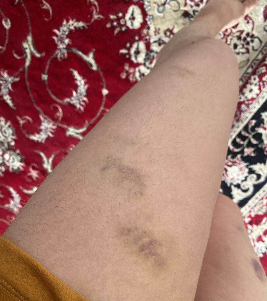 R6870S's tweet image. اینا جای لگدای ماموریه ک شب هیجدهم زد به پام ،تو ایرانم،کف خیابونم ،از همینجا بلند میگم نه سلطنت نه رهبری آزادی و برابری
#از_دموکراسی_بگو