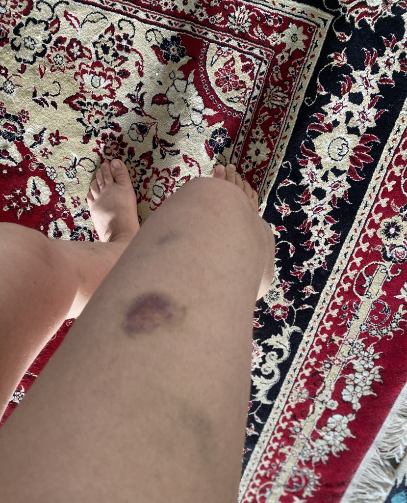 R6870S's tweet image. اینا جای لگدای ماموریه ک شب هیجدهم زد به پام ،تو ایرانم،کف خیابونم ،از همینجا بلند میگم نه سلطنت نه رهبری آزادی و برابری
#از_دموکراسی_بگو