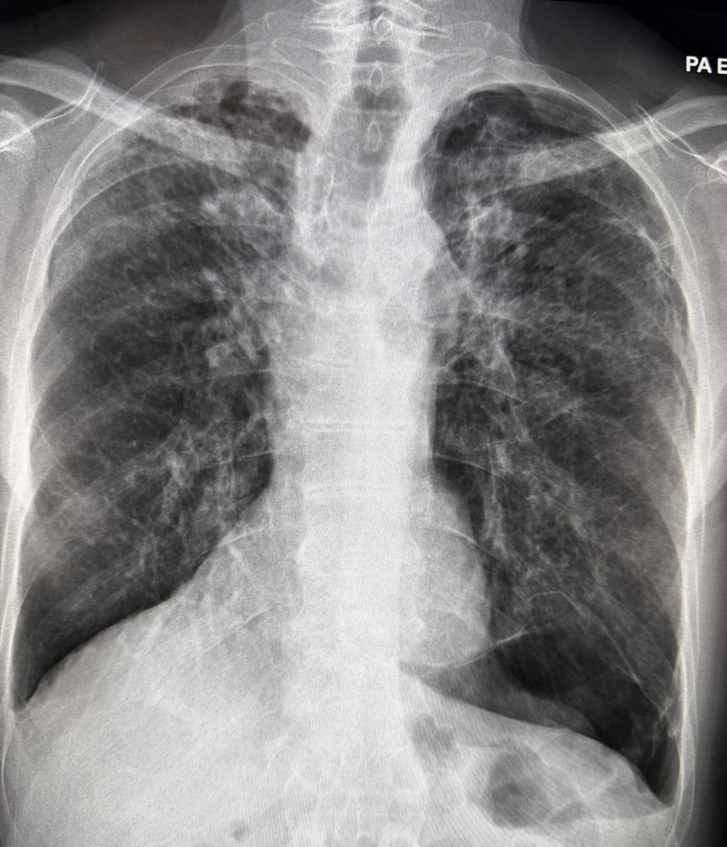 55 year old Patient H/o increasing shortness of breath.
<a href="/fzn733/">Faizan A.</a> 
<a href="/usernamee389/">.</a> 
<a href="/albertoortegana/">C.Alberto Ortega</a> 
<a href="/ChShafiullah15/">Chaudhary Shafiullah</a> 
<a href="/Dr_Shiv_kumar_/">Dr. Shiv_Kumar</a> 
<a href="/dr_manish_ydv/">अहिरावण</a> 
<a href="/SameerYogi14/">Dr Ajay yadav</a> 
<a href="/drabdulhameed07/">Dr Abdul Hameed 🩺</a> 
<a href="/MiguelP23970914/">Antonio Arroyo, MD. Medico Cirujano.</a>
