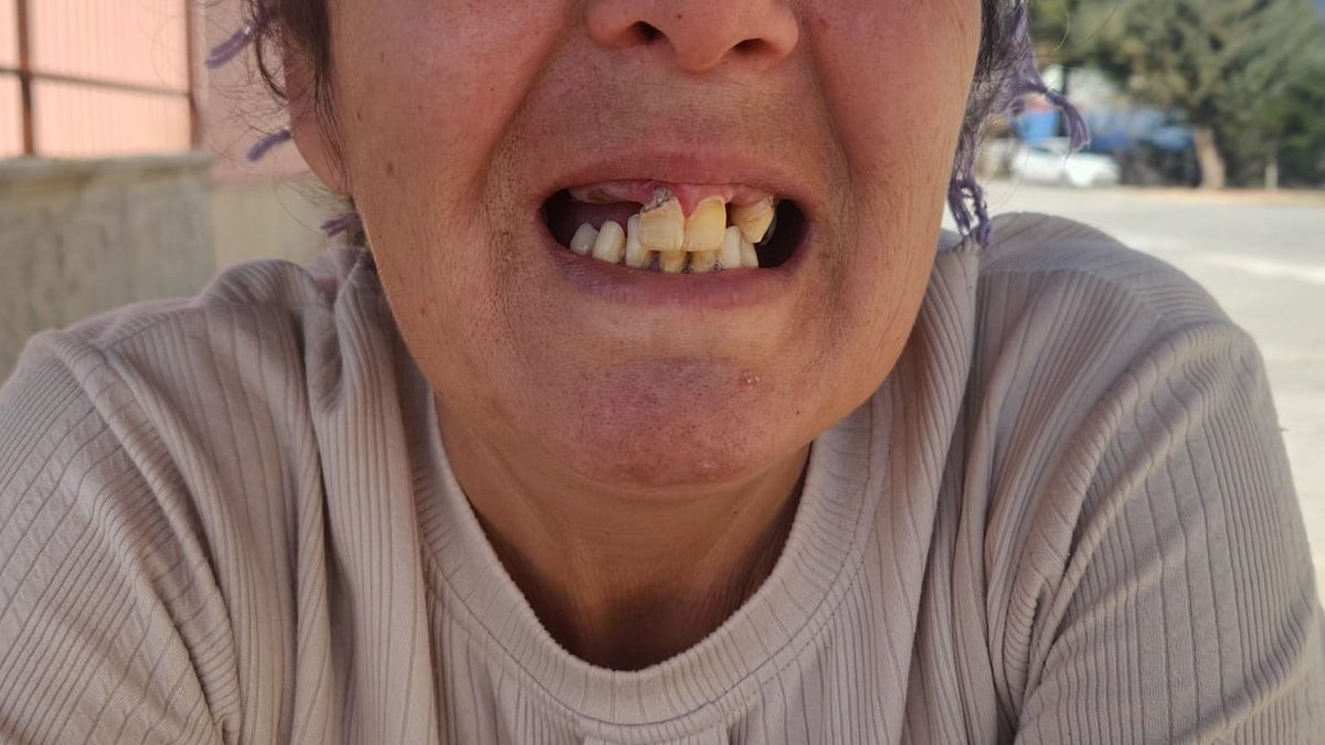 Sevgili arkadaşlar.

Yaşadığımız dağ ilçesinde ara ara garip gurebadan bahsediyorum. Şimdi önümüzdeki hayır hasenat işi, kocası ağır böbrek hastası olan ve ailesine bakmak için yırtınan bir ablamıza yapacağımız bir iş. Ablamızın dişleri gidik durumda ve buna muhtemelen "damak"