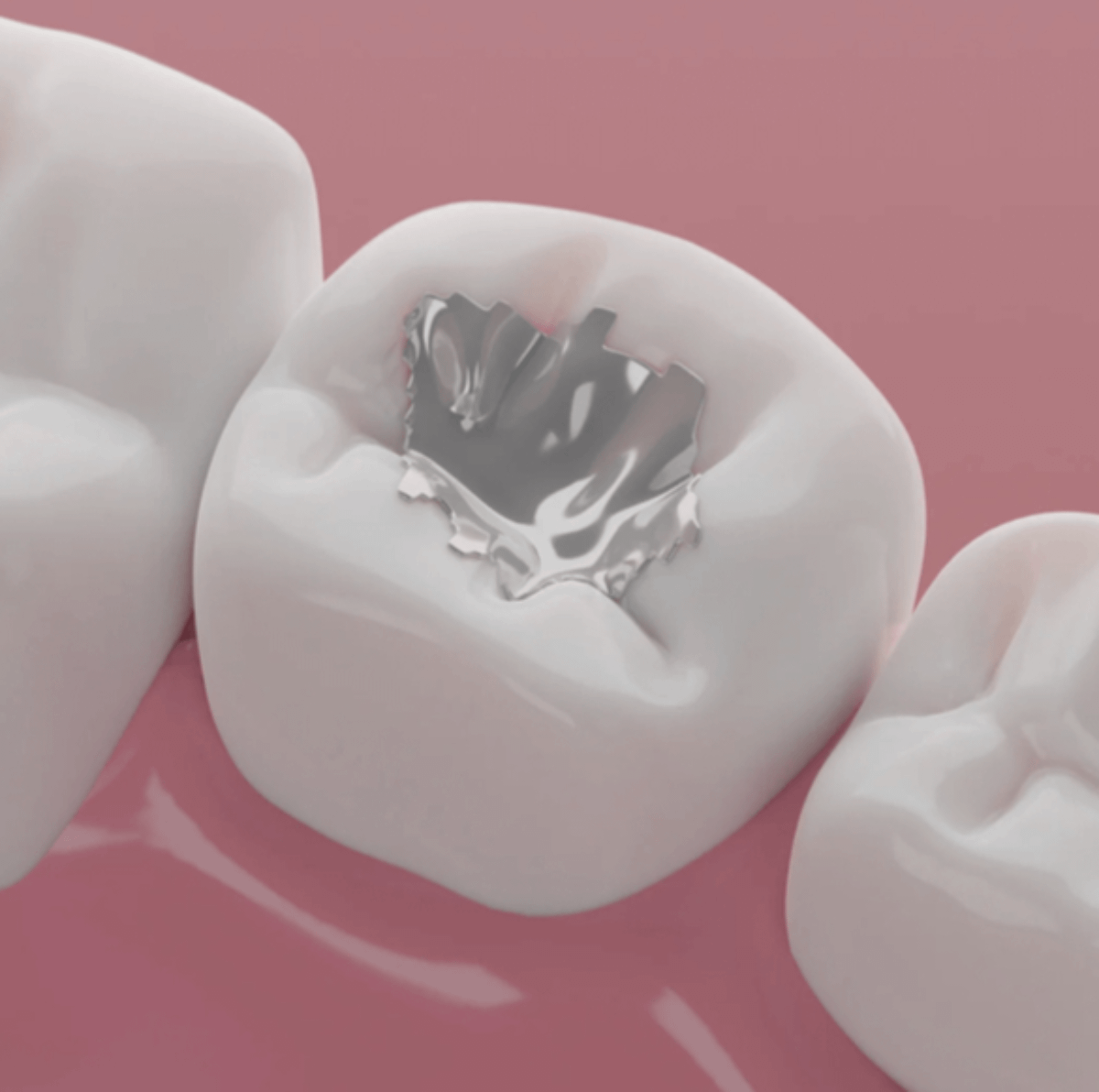 realPatrickJr's tweet photo. HUGE NEWS: I've been on the board of https://t.co/iBOSGAxP2w for 19 years.

Our mission was to ban mercury amalgams (i.e., silver fillings) in the USA.

It seems like we finally did it!

For over 150 years, dentists have been putting a known neurotoxin into people's mouths while calling them "silver fillings."

The truth is, they aren't actually silver.

These fillings are 50% elemental mercury. After a 19-year campaign led by https://t.co/iBOSGAxP2w, the US government has changed its stance. The use of mercury amalgams is coming to an end.

Mercury is one of the most poisonous substances on Earth that isn't radioactive.

We use hazmat protocols to clean it up if a thermometer breaks on a floor, but we have allowed it to sit right next to the human brain for decades. Every time you chew or drink a hot coffee, these fillings release vapors. The FDA has acknowledged that this mercury builds up in the brain and kidneys over time.

The Indian Health Service (IHS) recently announced it will ban mercury amalgams entirely by 2027.

HHS Secretary RFK Jr. described the move as a common sense step. This change aligns with the broader Make America Healthy Again (MAHA) goals, which focus on avoiding cheap, toxic materials in favor of safer alternatives.

The problem also extends past individual health.

When these fillings are removed or when bodies are cremated, the mercury gets into the water and soil. By switching to modern, mercury-free composites, the IHS is protecting tribal lands from this environmental contamination.

The medical field is finally moving toward a standard of care that doesn't sacrifice neurological health for a cheap dental repair.

It took 20 years of public pressure, but the science is finally winning out over old habits.