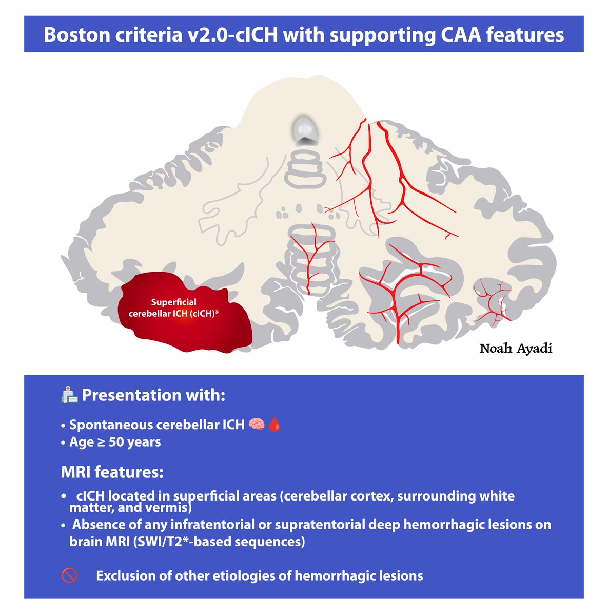 noah_ayadi's tweet photo. New paper in @GreenJournal 📄 

The cerebellum has long been a neutral territory in CAA diagnostics, despite growing evidence of cerebellar involvement. 

We propose pragmatic criteria for identifying CAA-associated cerebellar ICH. 🧠🩸

https://t.co/R2c3AtG1Aq 📜🔍 https://t.co/nmWIuVF8io