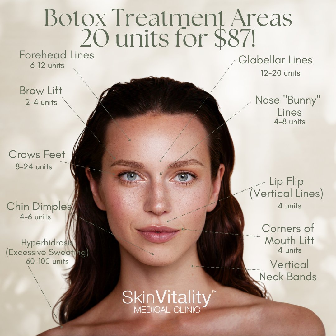 Botox® treatment areas, mapped with intention ✨
Placement and units vary by anatomy and movement goals.
20 units for $87 available.
📌 Book a complimentary consultation.
#BotoxCanada #MedicalAesthetics