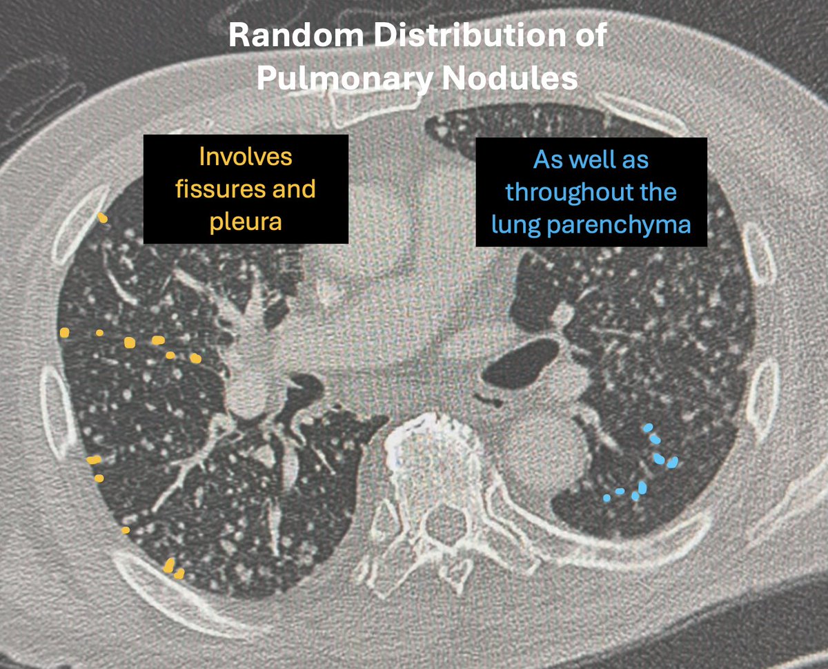 MaddiWulfeckMD's tweet photo. 🫁💥 Answer: Random (centrilobular + pleural-based) nodule distribution = hematogenous spread → pulmonary metastases.

🔥This is the classic “seeded by the bloodstream” pattern which can be seen with mets and infection:
🎯 scattered throughout all lobes
🎯 variable size
🎯 hits the periphery + deep lung equally

📌 Radiology pearl:
Random distribution = blood-borne = mets until proven otherwise.

#RadTwitter #ChestCT #Radiology #MedTwitter #Radres