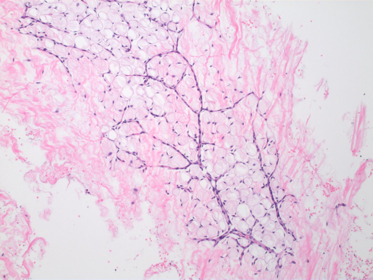 MhPathology's tweet photo. In case you’ve ever had difficulty seeing the fine network of capillaries in adipose tissue, this image is for you!

#pathology #MHPathology #cwru #PathTwitter #pathX https://t.co/l6XoBYJBLx