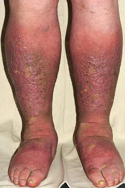 md1talk's tweet photo. اذا جيتم الصباح ولقيتم مريض متنوم عشان bilateral cellulitis 

في احتمالة كبيرة ان التشخيص غلط، وغالبا التشخيص هو ؟!! https://t.co/aJrF6rJ3T0