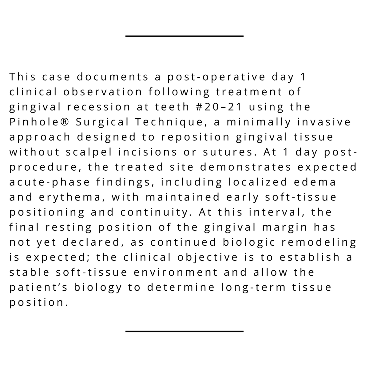JohnChaodds's tweet photo. Clinical Observation — Post-op Day 1 at #20–21 following Pinhole® Surgical Technique performed 02/09/26 (11:41–1:01, 80 min). Expected acute edema/erythema with maintained early tissue positioning. Final margin position has not yet declared. https://t.co/mgAuXMTL4u