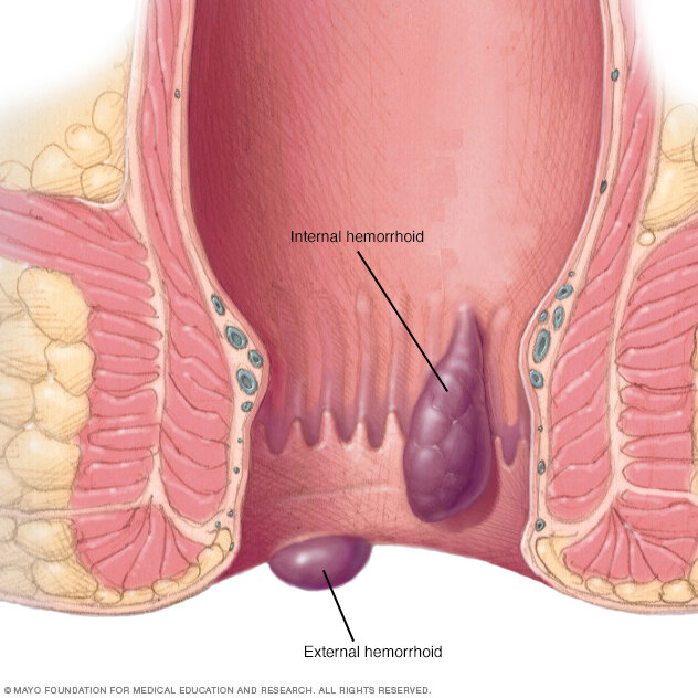 LM_Surgeon's tweet photo. LAS HEMORROIDES NO SON UNA ENFERMEDAD PER SÉ 👇 #CirugiaUmaeVeracruz
Son cojinetes vasculares normales del canal anal que contribuyen a la continencia. Hablamos de enfermedad hemorroidal cuando producen síntomas: sangrado, prolapso, dolor o prurito. 🧵 https://t.co/yymL0plkUI