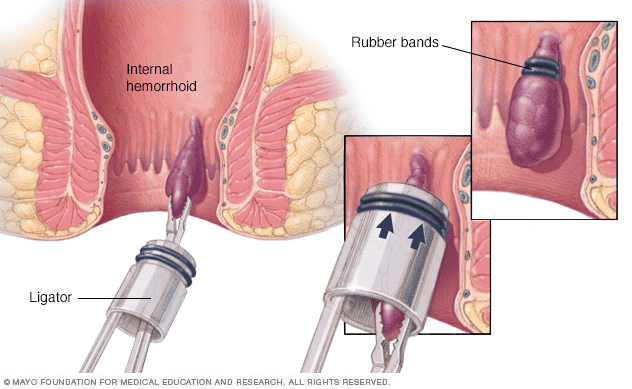 LM_Surgeon's tweet photo. 🔪TÉCNICAS QUIRÚRGICAS EMPLEADAS: 
1. Hemorroidectomía excisional.
2. Ligadura de arterias hemorroidales (HAL/Doppler) en casos seleccionados.
3. Hemorroidopexia engrapada: uso limitado, no de rutina https://t.co/0Ko5fwawMH