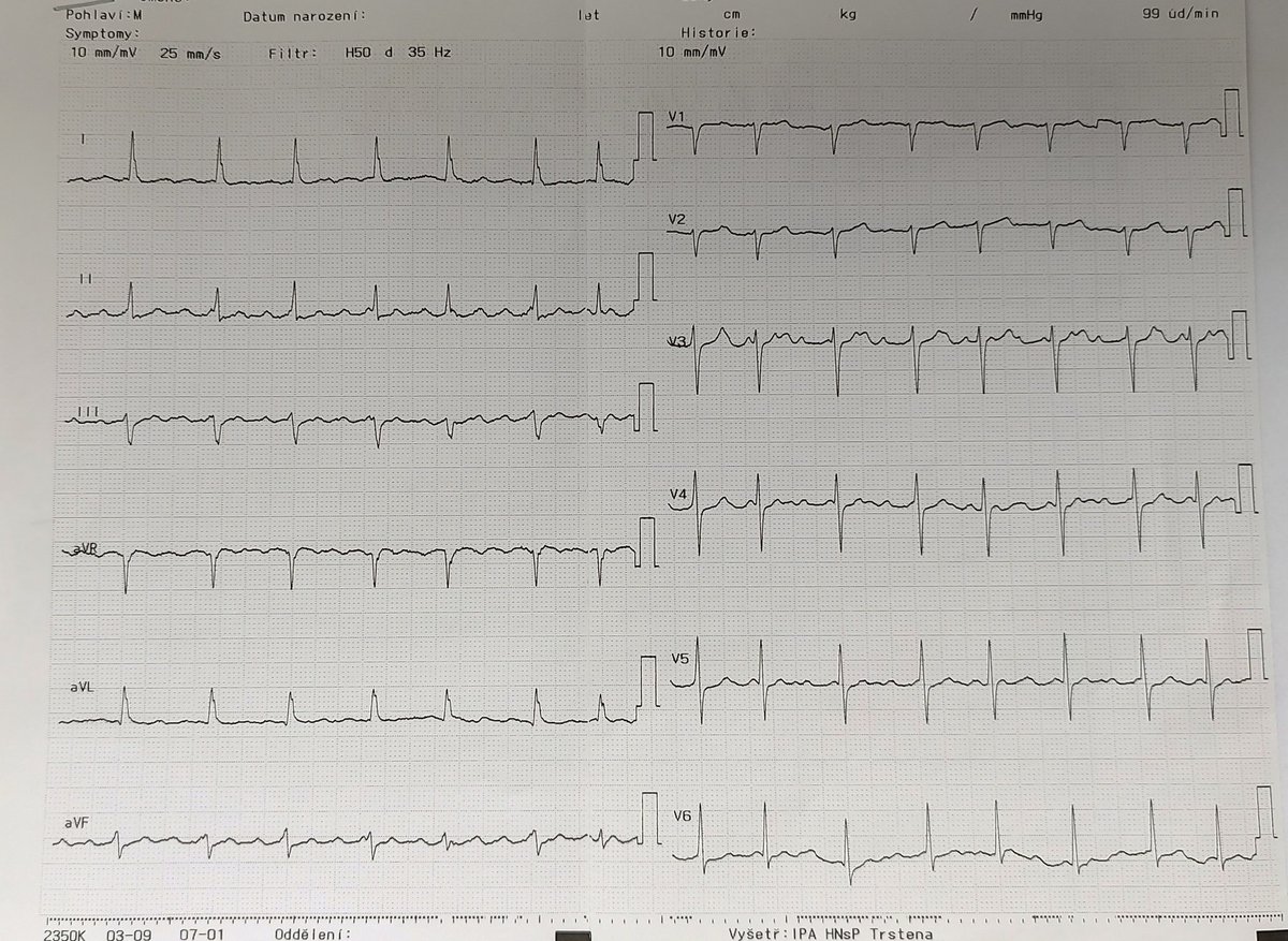 🧵 A case of macroreentrant atrial tachycardia or flutter with ECGs and ECG Holter 🧵
V3 looks like an AT with variable AV conduction while limb leads like an atrial flutter. ECG upon arrival to the hospital.