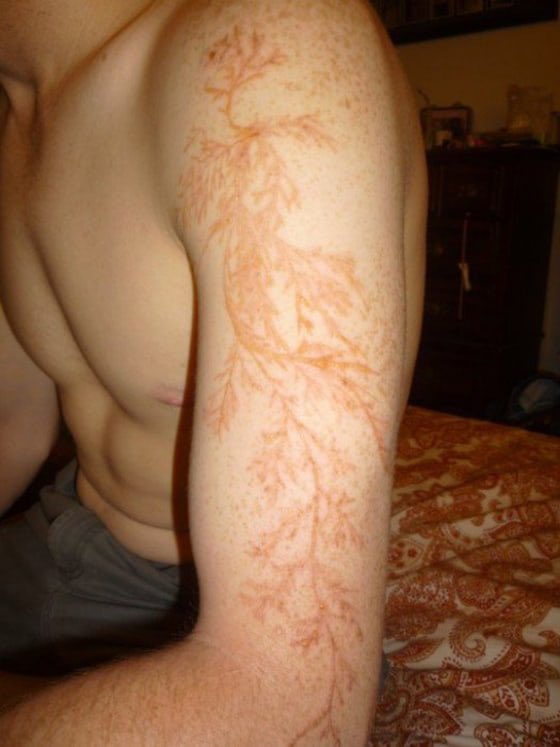 idyllicmusing's tweet image. There’s a pretty well-documented thing that happens to people who manage to survive a lightning strike or a heavy jolt of high-voltage electricity. These are called, “Lichtenberg Figures.”