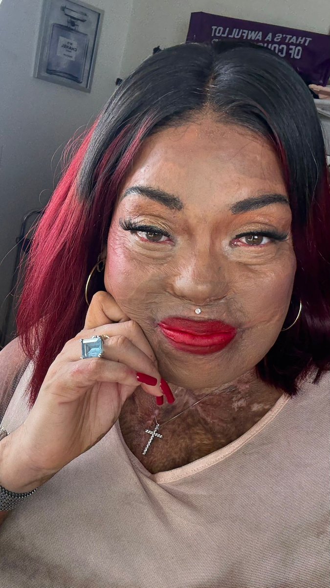 Tonya, aka BurnedBeauty2018 on social, has such a remarkable journey to share. You can see that she had a terrible accident. It happened at home. 3rd degree burns over 30% of her body. 
She has fought and fought to come back since that day in 2018, and has become a real