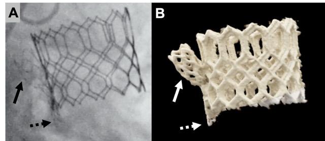 TaiebPhil's tweet photo. 🚨 New in JACC: Case Reports 🚨 First Report of Anchoring via Trans-Leaflet Apposition Stent (ATLAS): Leaflet Modification for Failing Non-Calcified Valves.

Read here: https://t.co/HOWkApN9uY

#CardioTwitter #TAVR #StructuralHeart #JACC #Cardiology 

@DvirDanny @JACCJournals https://t.co/EUCGtx04Pq