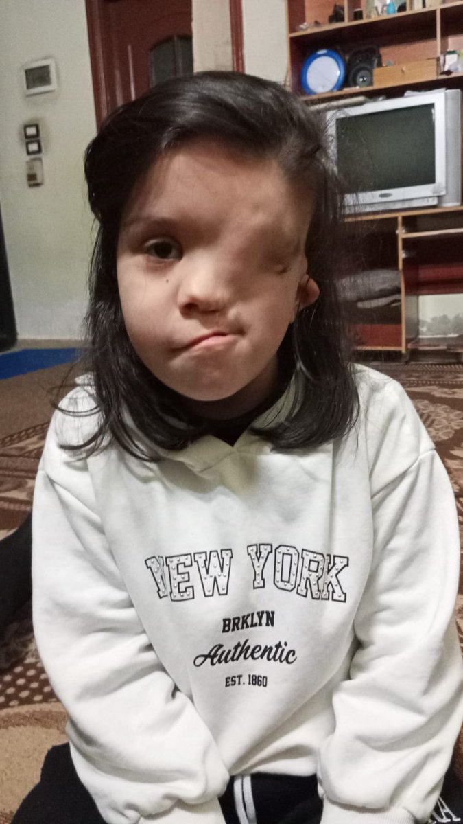 أحبتنا الكرام <a href="/KSRelief/">مركز الملك سلمان للإغاثة</a>
هذه بنت يتيمه ابنة إحدى الأخوات <a href="/nisrinn92560564/">نسرين الحمصية</a>
ضحية الكيماوي في سوريا قبل عدة سنوات وهي صغيرة 
تحتاج من يستطيع علاجها عن طريق مركز الملك سلمان للاغاثة او السفارة السعودية في دمشق 
او اي جهة أخرى 
الحالة تحتاج زراعة عين تجميلية 
إصلاح اعوجاج الفم 
إغلاق