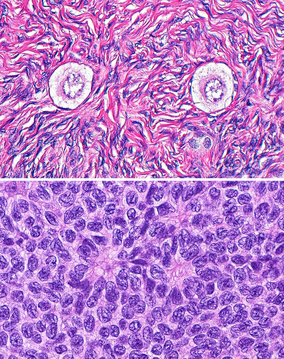 ziad_zaatari's tweet image. 🔬📸 "Duos" 🥚🥚 
 ~ 2 Primordial Follicles (Top) - Normal Ovary
 ~ 2 Call-Exner Bodies (Bottom) - Granulosa Cell Tumor
    #Pathology #GYNpath #Histology #PathArt