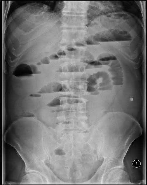 A legacy X-ray of a patient with pain and vomiting. What is the diagnosis?
#Medtwitter #FOAMed <a href="/DrAkhilX/">Dr. Akhil 🇮🇳</a> <a href="/dr_manish_ydv/">अहिरावण</a> <a href="/Dr_Shiv_kumar_/">Dr. Shiv_Kumar</a> <a href="/Dr_Shiv_kumar_/">Dr. Shiv_Kumar</a> <a href="/DrArslan480/">The Medics🩺💊💉🏥</a>