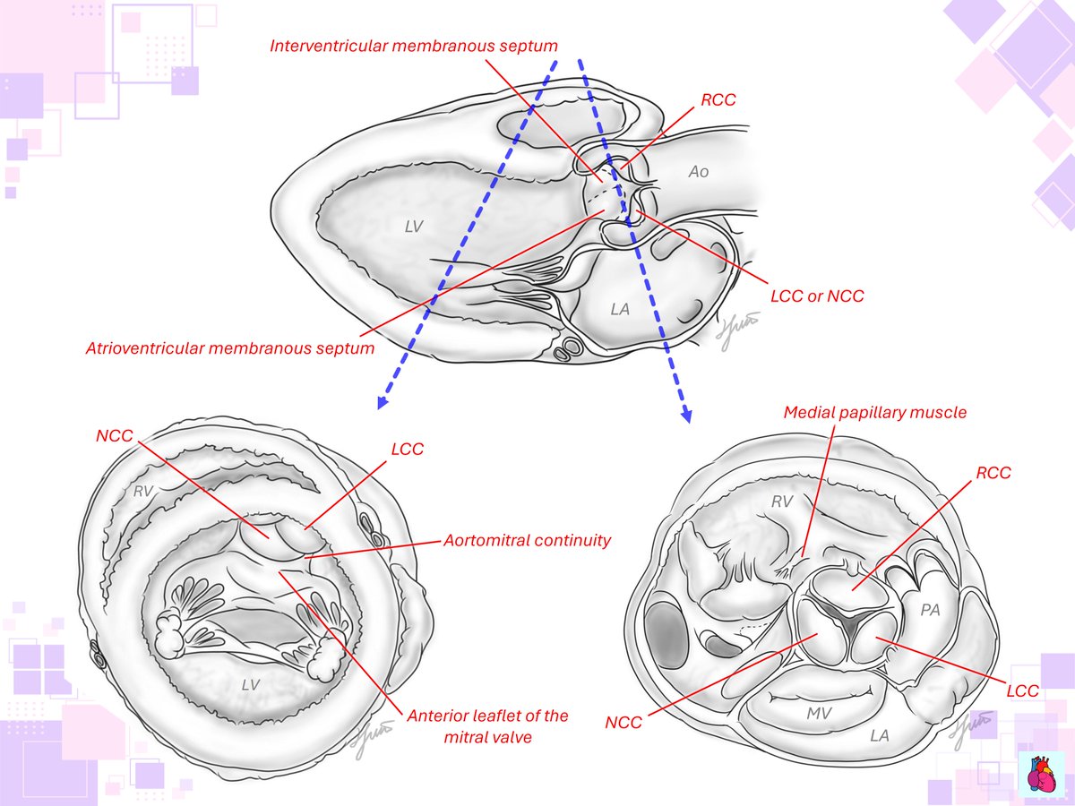 WithAScalpel's tweet image. True—integrating echo views with anatomic images in our mind is how we truly understand morphology and physiology. 
👉Practice, then practice again.

On PLAX, the aortic cusp adjacent to the RVOT (parietal band) is the RCC.

#POCUS #Nephpearls #FOAMed
@NephroP @HoosierPocus