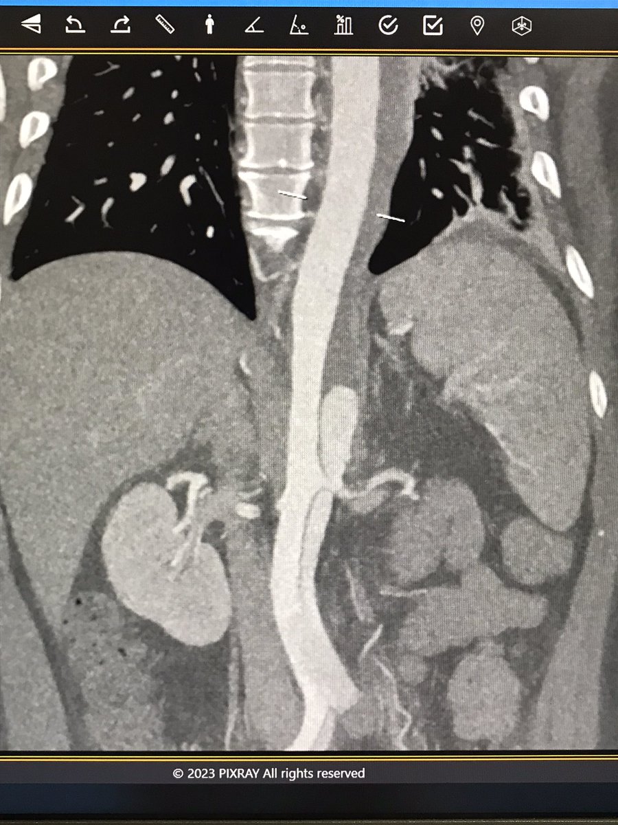 YoushaBarca's tweet photo. 38yo male, poor control HTN
Is there a need to cover from LSCA to entrance with stentgraft?(its thrombosed)
This would require a long stent, increasing the risk of SCI. Whats your solution?
#dissection #endovascular #aorta
@Toursavadkohi
@farkomd
@AidinBaghbaniMD
@pcvasc
@docpark https://t.co/1sR5XLlE8g