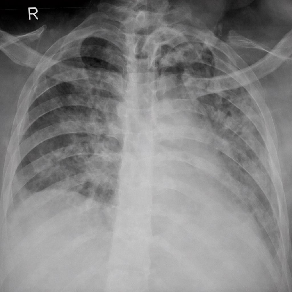 A 42-year-old male with acute necrotizing pancreatitis presents on day 3 with worsening dyspnea. He is tachypneic and hypoxic. ABG on room air shows:
• PaO₂ = 55 mmHg
• PaCO₂ = 32 mmHg
• pH = 7.48

Chest x ray attached. Pulmonary capillary wedge pressure is 10 mmHg. Serum