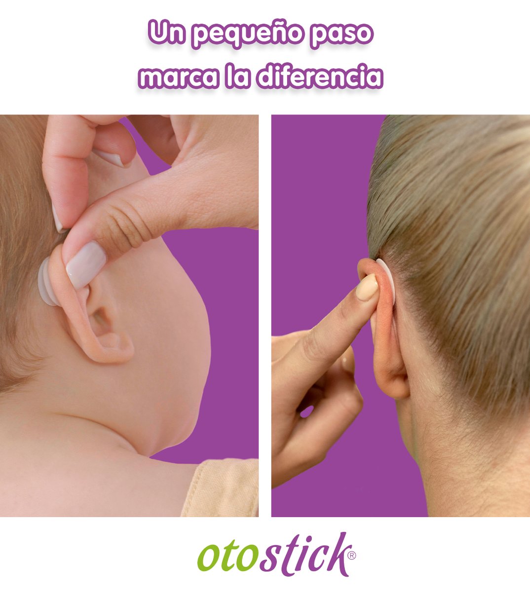 Antes de colocar Otostick, identifica el punto exacto donde irá colocado y simula su efecto para ver el resultado. ¡Así te aseguras de que quede perfecto! 😉👂🏼

otostick.com
💜💜💜💜