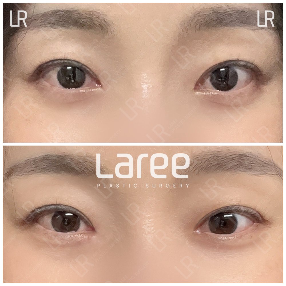 lareeclinic's tweet photo. 片目が開きづらく、目を開けるときに額に力が入るクセがあり
これまで額ボトックスを���けていらした方が
当院で目つき矯正と目の下脂肪再配置を受けられました。

重たく見えていた目元やラインがすっきり整い
明るくいきいきとした印象に✨

← 術前｜術後（3ヶ月） → https://t.co/dCjFsQEong