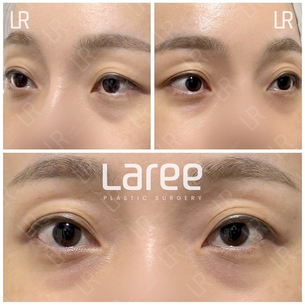 lareeclinic's tweet photo. 片目が開きづらく、目を開けるときに額に力が入るクセがあり
これまで額ボトックスを���けていらした方が
当院で目つき矯正と目の下脂肪再配置を受けられました。

重たく見えていた目元やラインがすっきり整い
明るくいきいきとした印象に✨

← 術前｜術後（3ヶ月） → https://t.co/dCjFsQEong