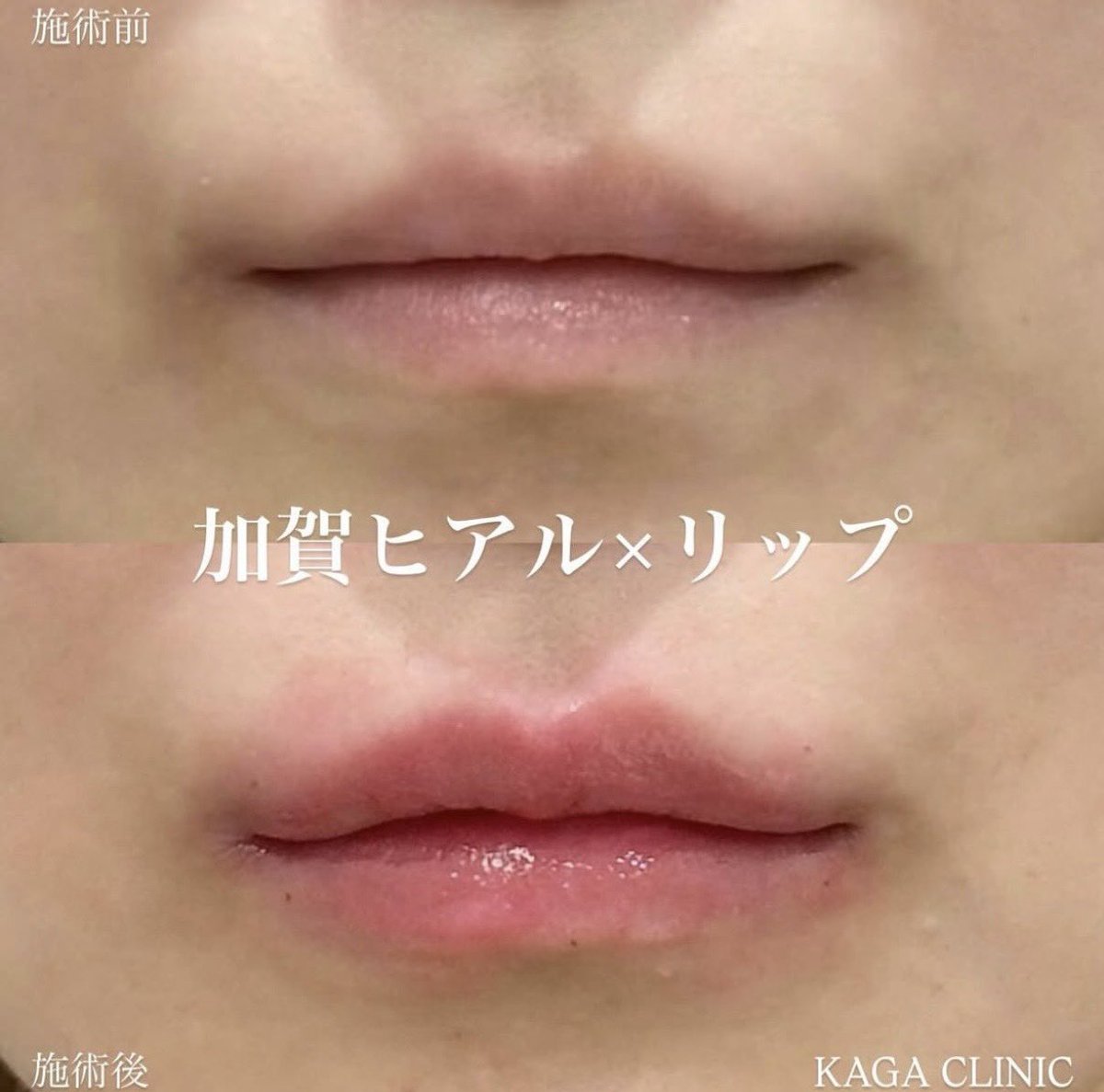 _2318h's tweet photo. 国内で唇ヒアルだとKAGA CLINICの加賀先生の症例が一番タイプ💞
唇ヒアルって手軽だけどめっちゃ整形感出やすいから気を付けないとなんだけど、加賀先生の症例はナチュラルなのにしっかり変化してて口角きゅるんだし、顔の余白埋めたい私としては口の横幅広がるの最高.ᐟ.ᐟ https://t.co/4UX8HYoVfE