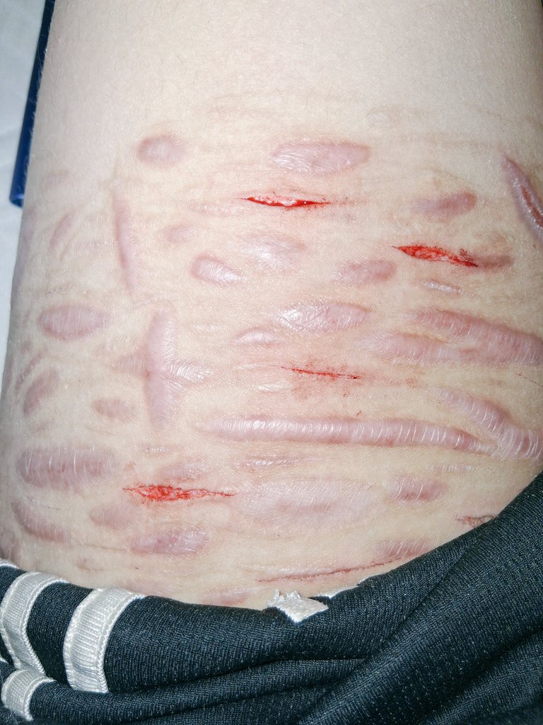 LaFayette_shtwt's tweet photo. Some of my older cuts to start off with:] 
#shedtwt #raspberryfilling #SELFHARMTRIGGERWARNING #styrostwt https://t.co/96oOUqNa63