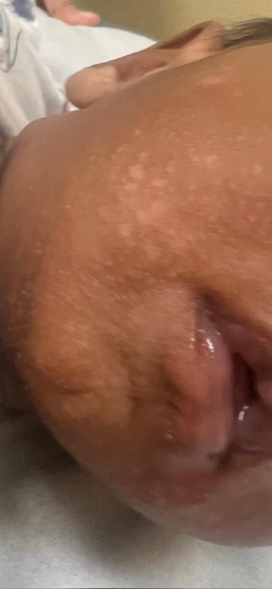 Only 2 months . what do you think this baby is having?
<a href="/IhabFathiSulima/">Dr Ihab Suliman</a> #MEDHTM <a href="/hemo_shk/">Dr.Haitham Hamoud | د.هيثم</a> @Jkbjb1 #TooCloseToDiagnose <a href="/MoarSahitoPTI/">Dr. Muhammad Moor</a>
<a href="/MRCEMPREP/">Daily Dose of Medicine</a>
<a href="/neoskinhealer/">Dr. ISHWAR N RATHORE MD</a> <a href="/DrBassemKurdi/">د. باسم | طبيب أطفال</a>
@mohammadalmo