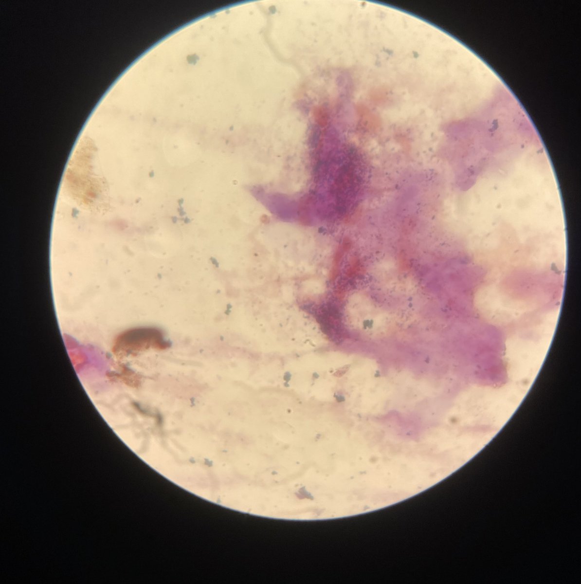 IjabaniG's tweet photo. Clue cells in a High Vaginal Swab (HVS) direct gram, these are vaginal epithelial cells coated with the anaerobic gram-variable coccobacilli Gardnerella vaginalis and other anaerobic bacteria causing bacterial vaginosis. The cytoplasm appears fuzzy like shading with black pencil. https://t.co/PQtRAtYBPG