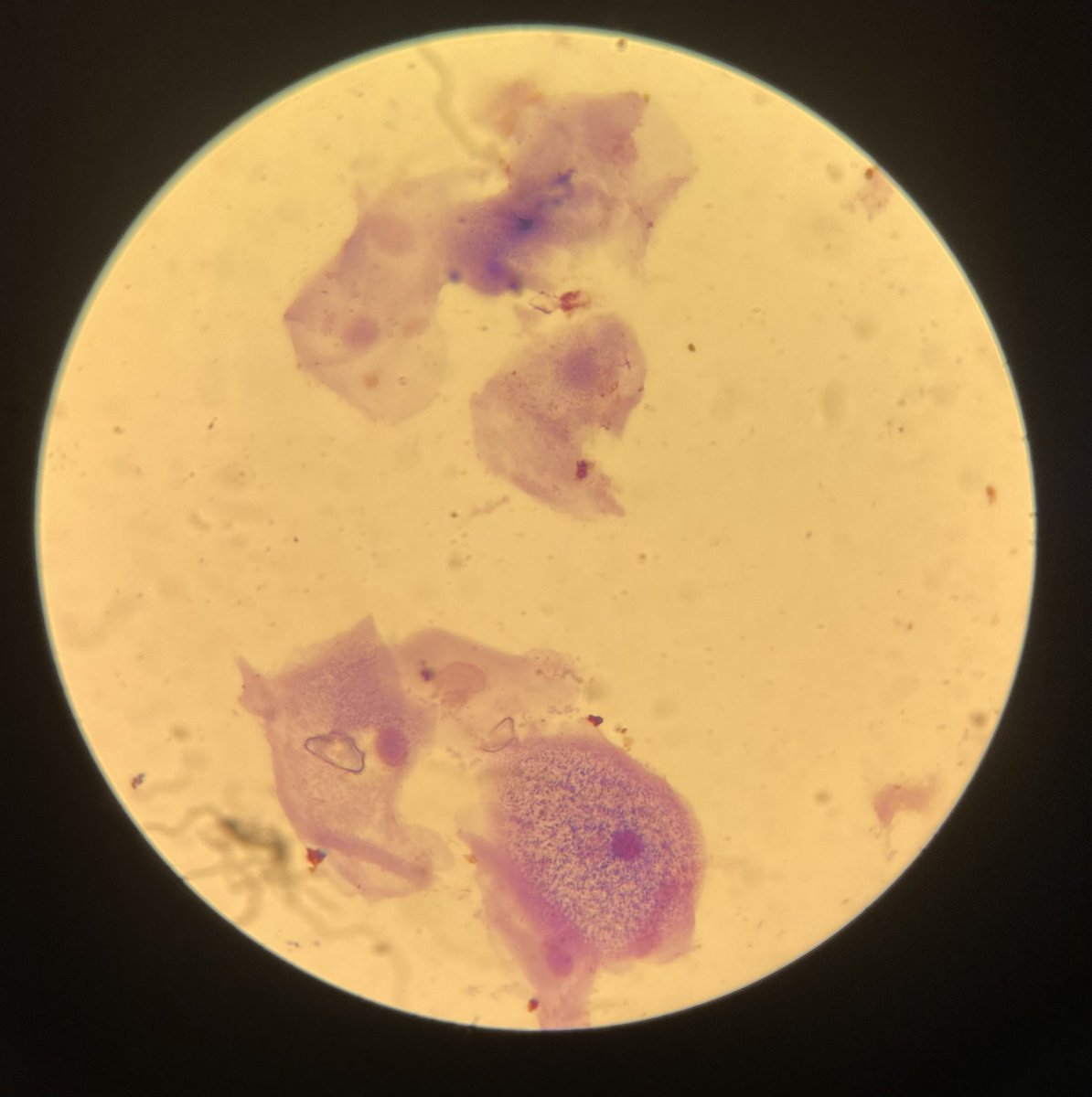 IjabaniG's tweet photo. Clue cells in a High Vaginal Swab (HVS) direct gram, these are vaginal epithelial cells coated with the anaerobic gram-variable coccobacilli Gardnerella vaginalis and other anaerobic bacteria causing bacterial vaginosis. The cytoplasm appears fuzzy like shading with black pencil. https://t.co/PQtRAtYBPG