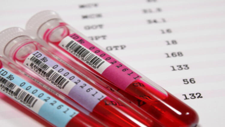 Kan Tahlili Parametreleri ve Anlamları

WBC (Lökosit): Bağışıklık hücreleri. ↑ Enfeksiyon, ↓ bağışıklık baskılanması.

RBC (Eritrosit): Kırmızı kan hücreleri. ↓ Anemi, ↑ susuzluk.

HGB (Hemoglobin): Oksijen taşıma kapasitesi. ↓ Anemi, kan kaybı.

HCT (Hematokrit): Kanın