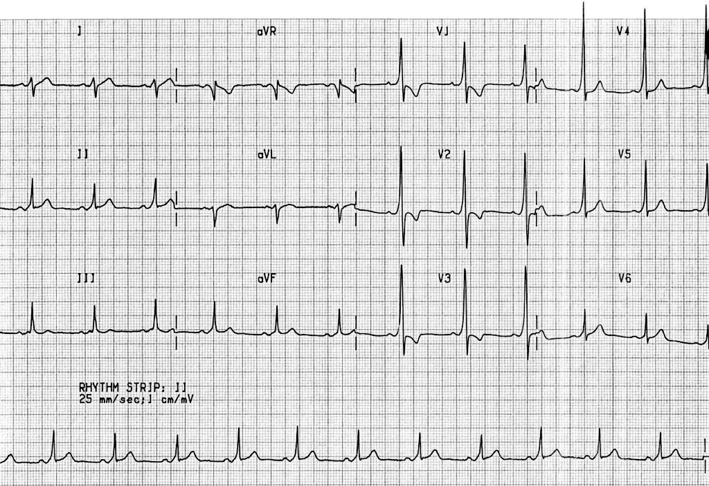 This ECG pattern is diagnostic of?

A. Left bundle branch block
B. Acute myocardial infarction
C. Wolff-Parkinson-White (WPW) syndrome
D. Hyperkalemia

#NEETPG #MedTwitter <a href="/DrAkhilX/">Dr. Akhil 🇮🇳</a> <a href="/DocPriyamMD/">Dr. Priyam Bordoloi</a> <a href="/Dr_Shiv_kumar_/">Dr. Shiv_Kumar</a> <a href="/MiguelP23970914/">Antonio Arroyo, MD. Medico Cirujano.</a> <a href="/DrMedica_13/">Dr. Medica🩺</a> <a href="/MedLearnHub/">MedLearn Hub</a> <a href="/Medzonetv/">Medzonetv</a>