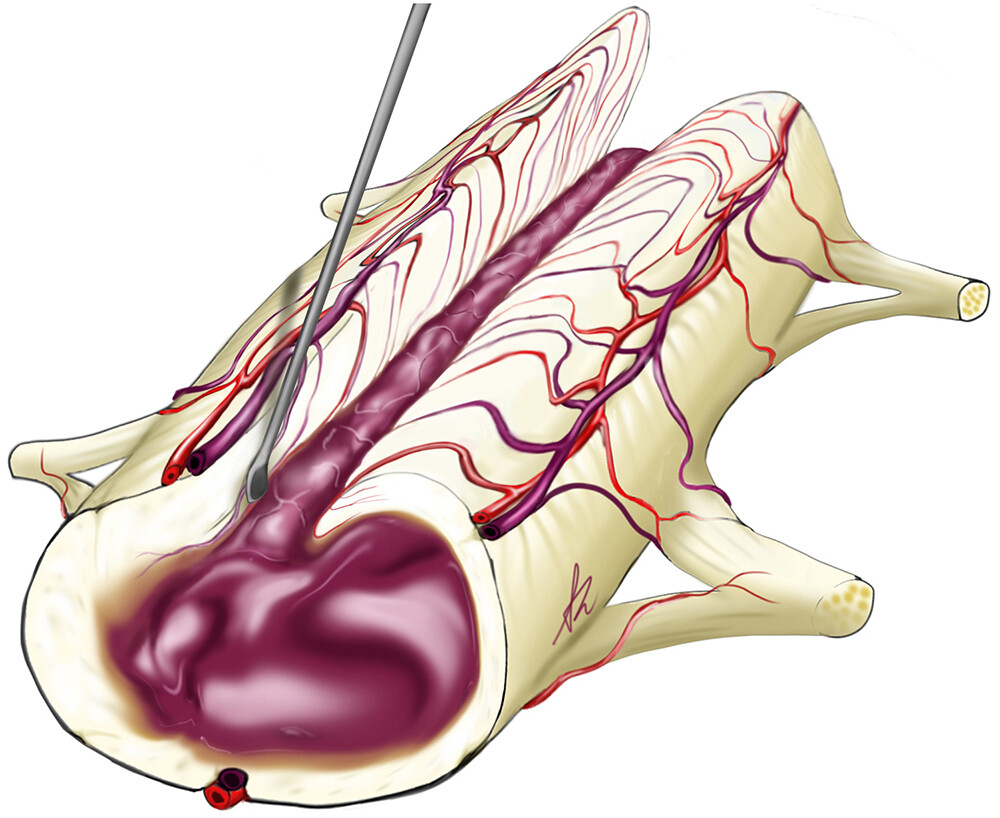 TheJNS's tweet image. #OnlineFirst: Predictive factors of long-term dorsal column dysfunction after intramedullary spinal cord tumor resection: a comparative case series.

thejns.org/spine/view/jou…
