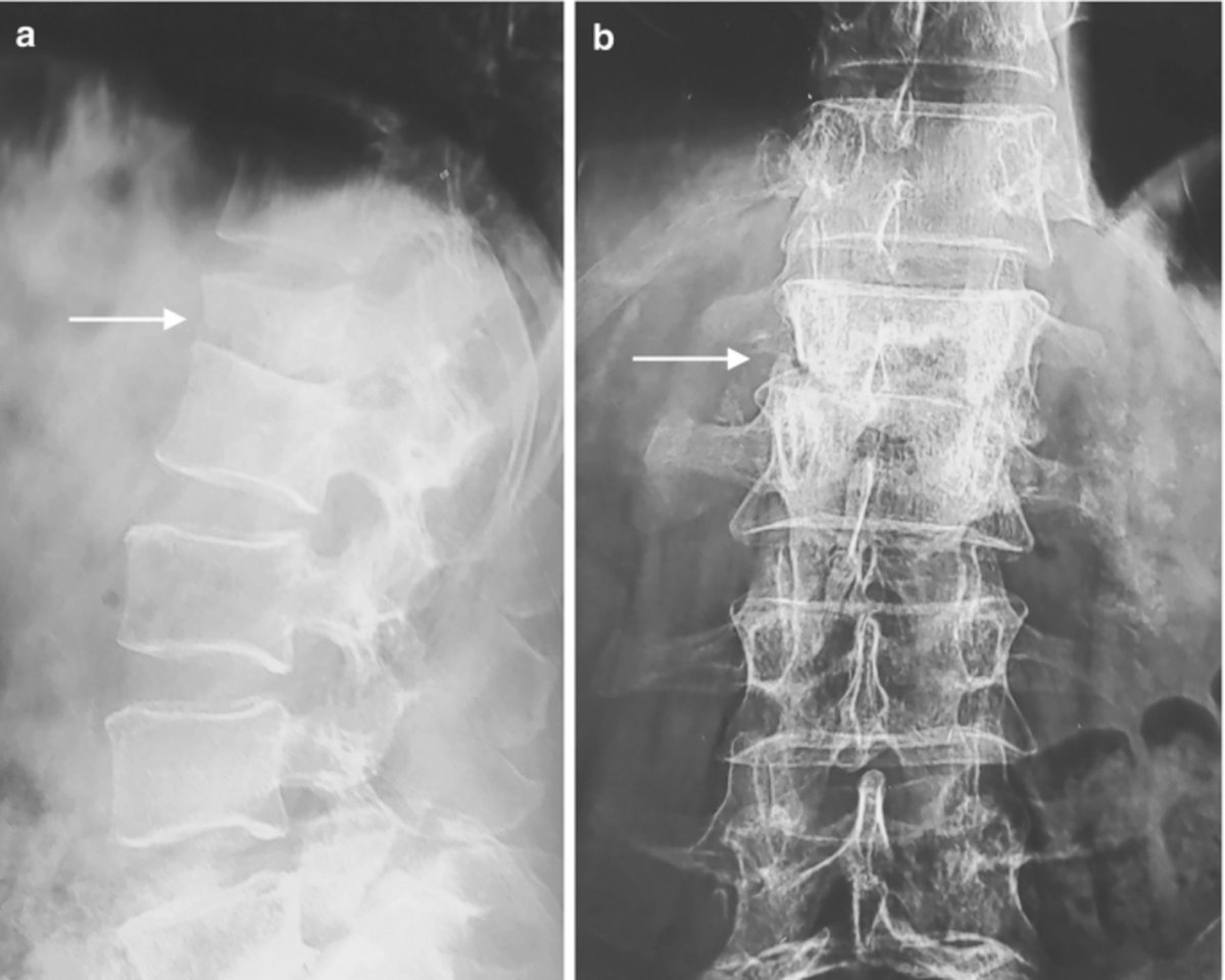This spinal X-ray appearance is classic for?
A. Tuberculosis (Pott's spine)
B. Rheumatoid arthritis
C. Ankylosing spondylitis
D. Osteoporosis
#NEETPG #MedTwitter <a href="/DrAkhilX/">Dr. Akhil 🇮🇳</a> <a href="/MiguelP23970914/">Antonio Arroyo, MD. Medico Cirujano.</a> <a href="/DocPriyamMD/">Dr. Priyam Bordoloi</a> <a href="/Dr_Shiv_kumar_/">Dr. Shiv_Kumar</a> <a href="/DrMedica_13/">Dr. Medica🩺</a> <a href="/Sage_medics/">SAGE MEDICAL⚕️</a>