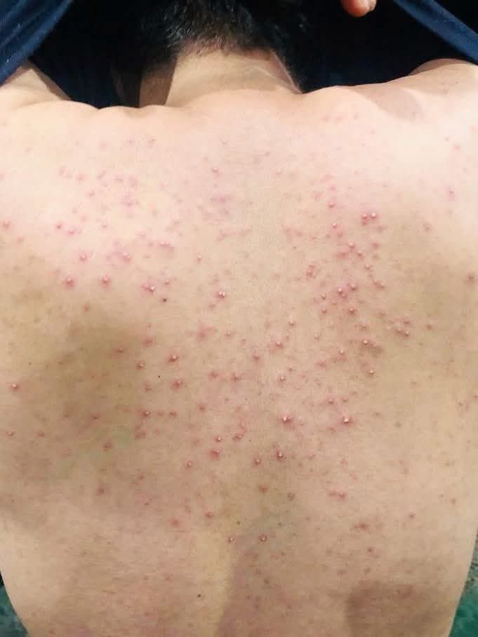 hemo_shk's tweet photo. #Dermatology 

What is the diagnosis?! https://t.co/eppFTY5a3a