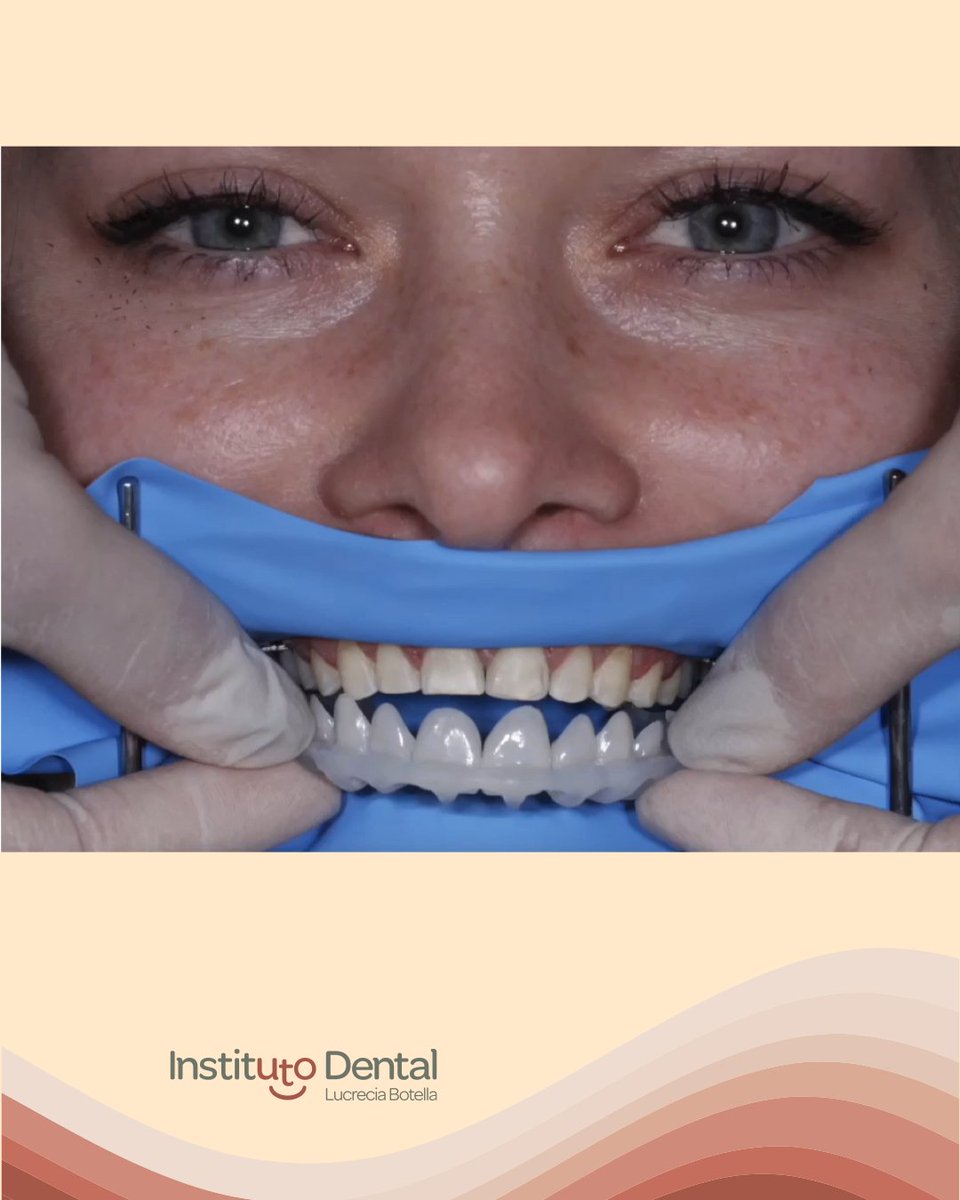 LucreciaBotella's tweet photo. Carillas guiadas FirstFit: estética dental digital más precisa, rápida y mínimamente invasiva. Ya disponible en Torrevieja.

👉 https://t.co/t3d3kcnSX7…

#EstéticaDental #CarillasDentales #Torrevieja #OdontologíaDigital #dentista #lucreciabotella https://t.co/QFH23XpSmN