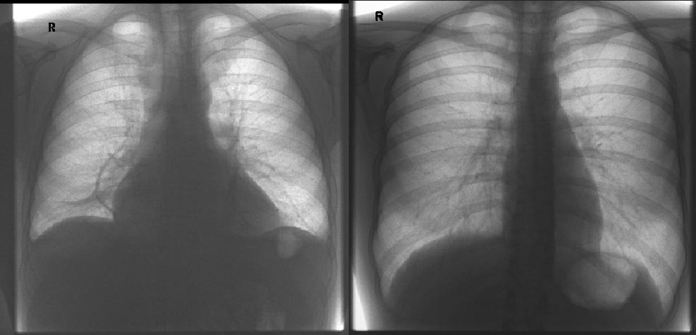 ⭕ A 45-year-old male presents with progressive dyspnea, orthopnea, and pedal edema for 3 months. Chest X-ray comparison is shown. The right image shows a normal cardiac silhouette, while the left image shows an enlarged globular cardiac shadow. What is the most likely diagnosis