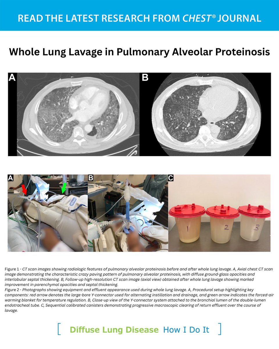 accpchest's tweet image. The latest CHEST How I Do It on whole lung lavage aims to enhance safety, reproducibility, and long-term monitoring to reduce recurrence and improve outcomes in pulmonary alveolar proteinosis.

Read more: hubs.la/Q04115Zb0
#MedEd #JournalCHEST #LungDisease
