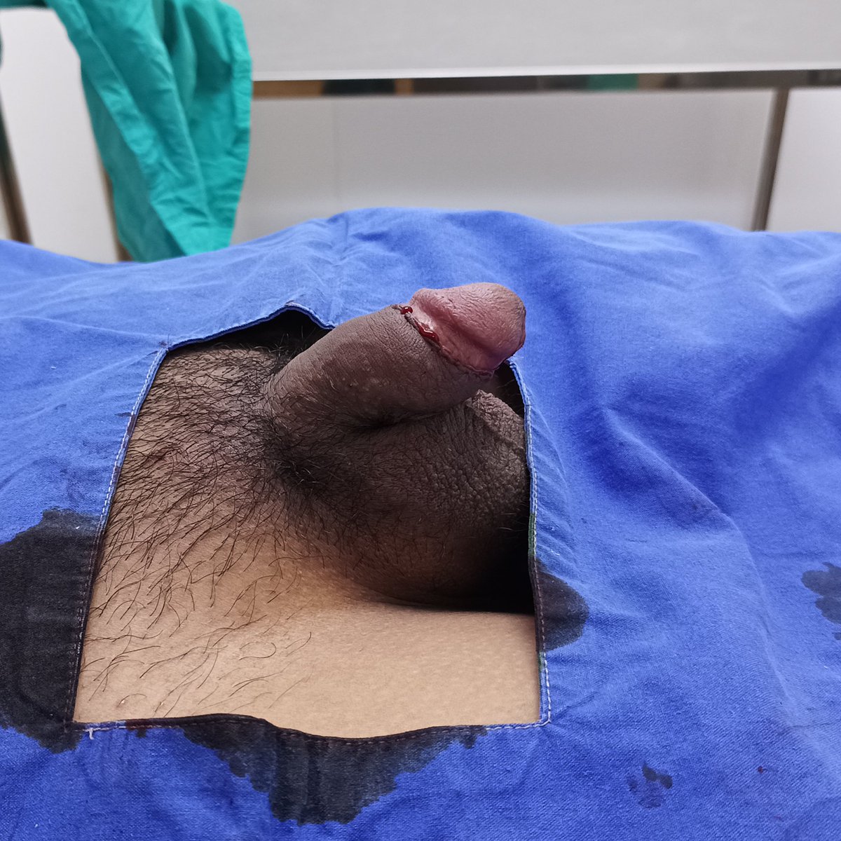 ปัญหากลิ่นอับ ที่น้องชาย
Men plus แก้ได้‼️😱

📌ขลิบ Sleeve Technique 💉
ก่อนทำ // หลังทำ

BY :  นพ.ดนูวิทย์ ใจแก้ว ว.56103 👨🏻‍⚕️
" แพทย์เฉพาะทางศัลยศาสตร์ยูโร "

11.02.69 #ทำที่คลินิก