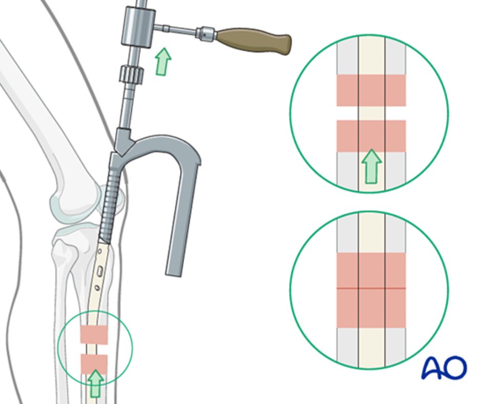 AO Surgery Reference tweet media