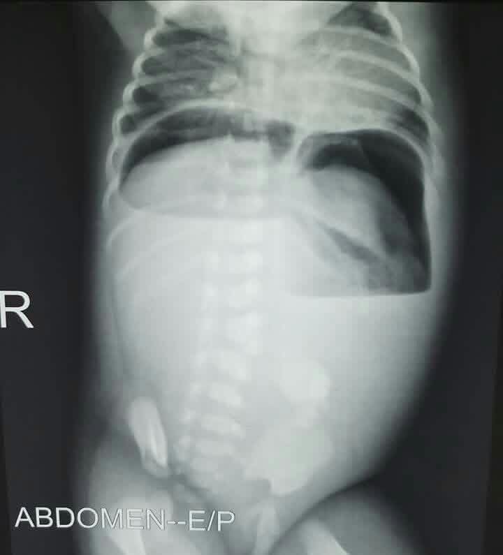 hemo_shk's tweet image. #Xray
#Radiology 

Diagnosis ⁉️🩻